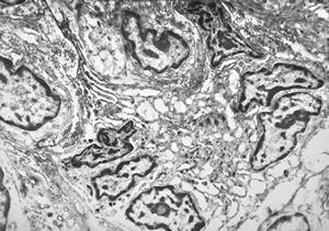 F,41y. | synovial metaplasia - capsule of implantate F,41y. | synovial metaplasia - capsule of implantate